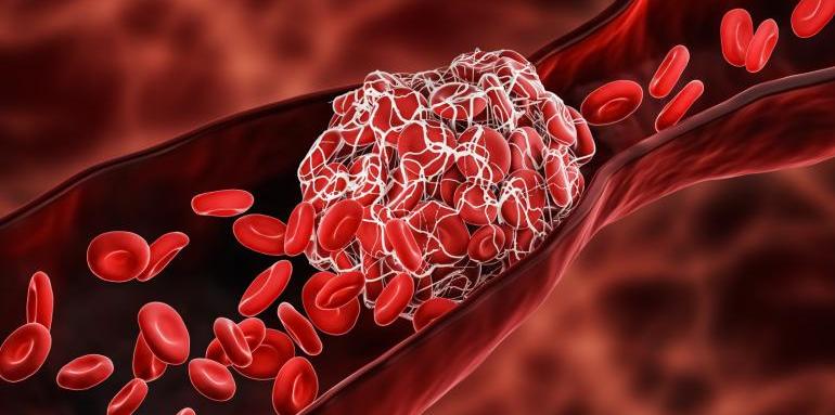 Учени откриха защо се образуват кръвни съсиреци