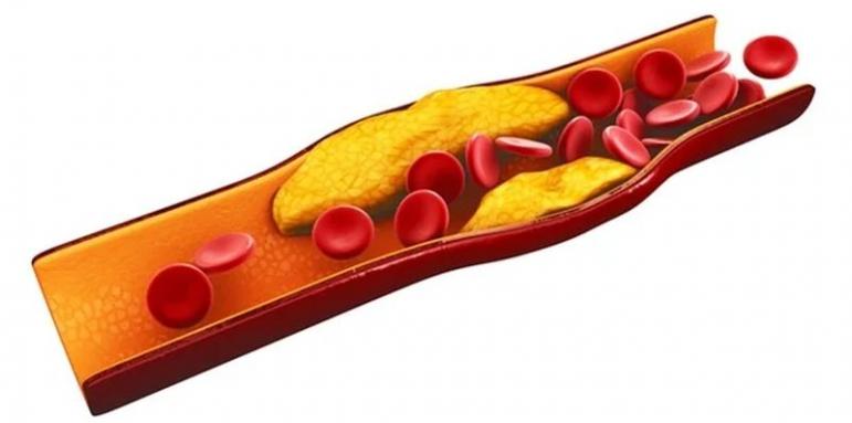 Лекарка даде 5 начина за справяне с лошия холестерол
